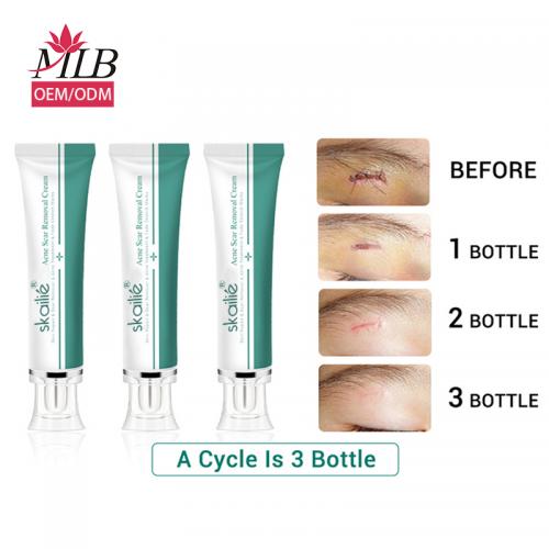 Creme para remoção de cicatrizes de acne